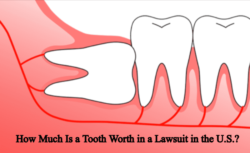 How Much Is a Tooth Worth in a Lawsuit in the U.S.? Complete Guide